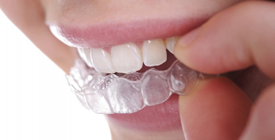 clear_aligners