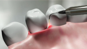 laser_dentistry