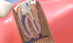 root_canal