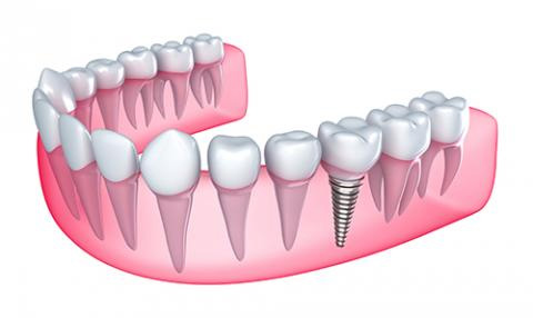 teeth_replacement